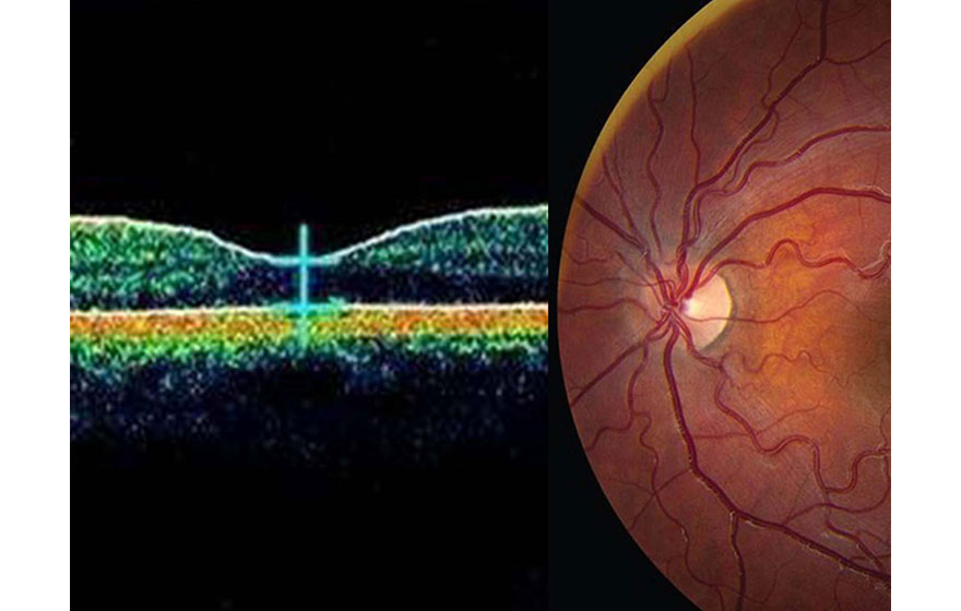 Scanner Optics Galvanometer in Medical Aesthetics/Dermatology
