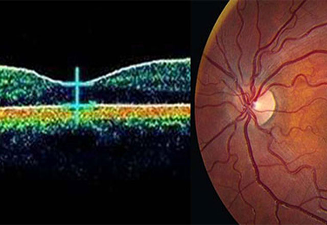 Scanner Optics Galvanometer in Medical Aesthetics/Dermatology